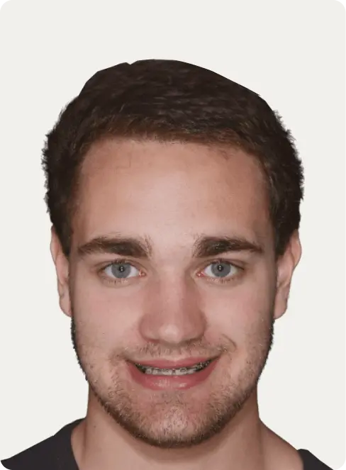 Image of a patient before Dental Implants at Macquarie Street Dental.