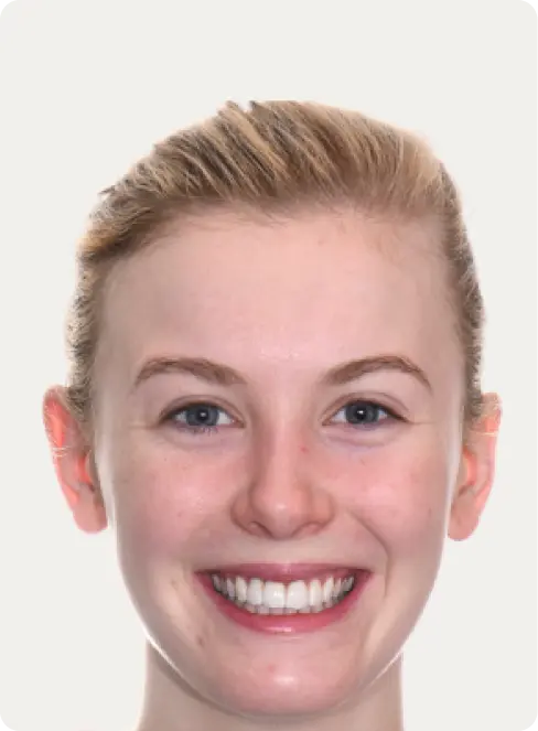 Image of a patient after Dental Implants at Macquarie Street Dental.