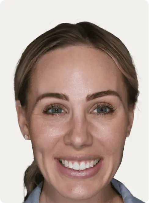 Image of a patient after Invisalign treatment at Macquarie Street Dental.