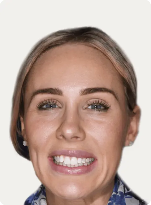 Image of a patient before Invisalign treatment at Macquarie Street Dental.