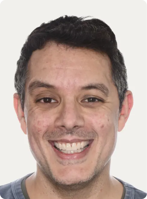 Image of a patient after Invisalign treatment at Macquarie Street Dental.