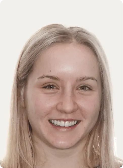 Image of a patient after Porcelain Veneers at Macquarie Street Dental.