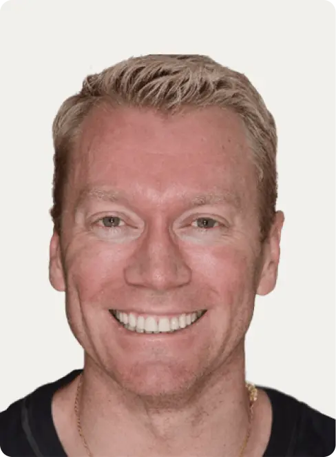 Image of a patient before Porcelain Veneers at Macquarie Street Dental.