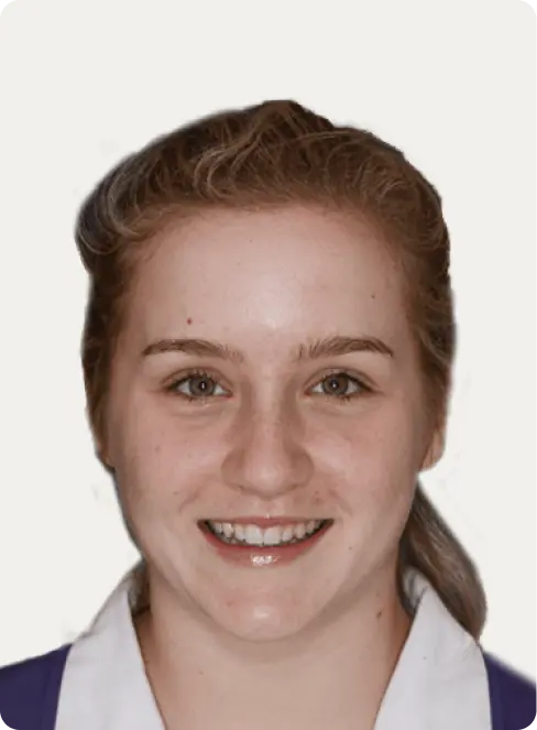 Image of a patient before Porcelain Veneers at Macquarie Street Dental.