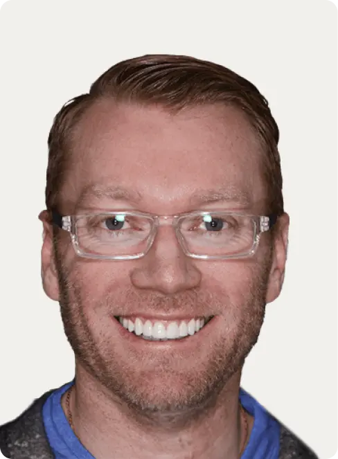 Image of a patient after Porcelain Veneers at Macquarie Street Dental.