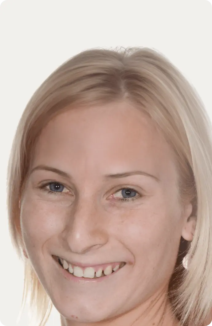 Photo of a patient before having a Smile makeover at Macquarie Street Dental.