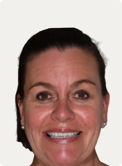 Photo of a patient before having a Smile makeover at Macquarie Street Dental.