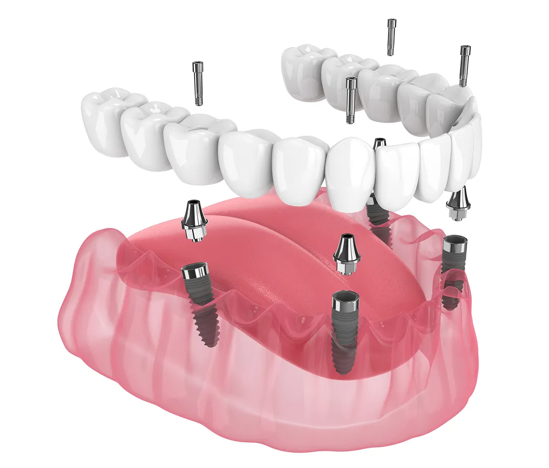 Illustration of all on 4 dental implants used in Sydney.