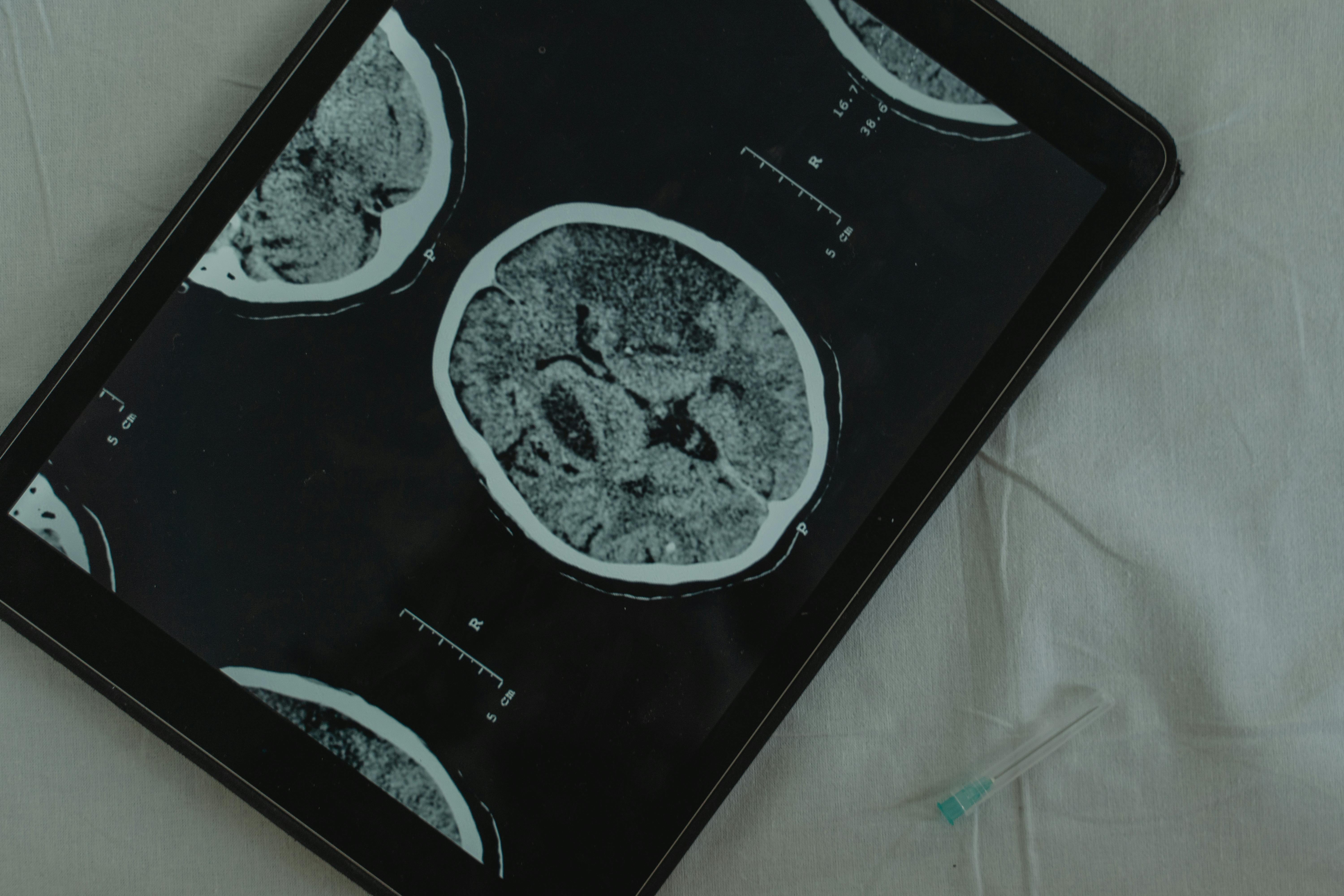 Cerebral Palsy and Autism: What Are the Major Differences?
