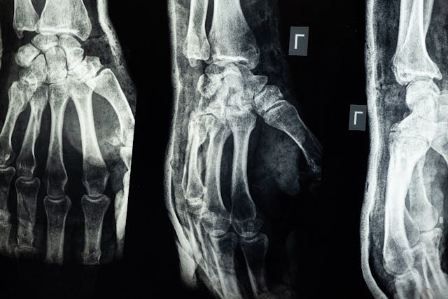 Do People With Autism Get Injured More?