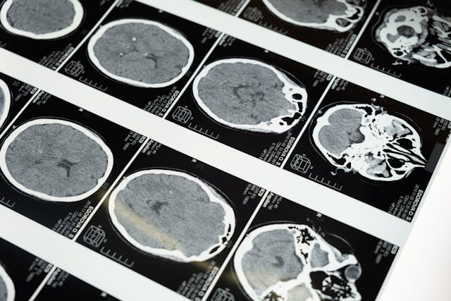 The Serotonin System in Autism Spectrum Disorder