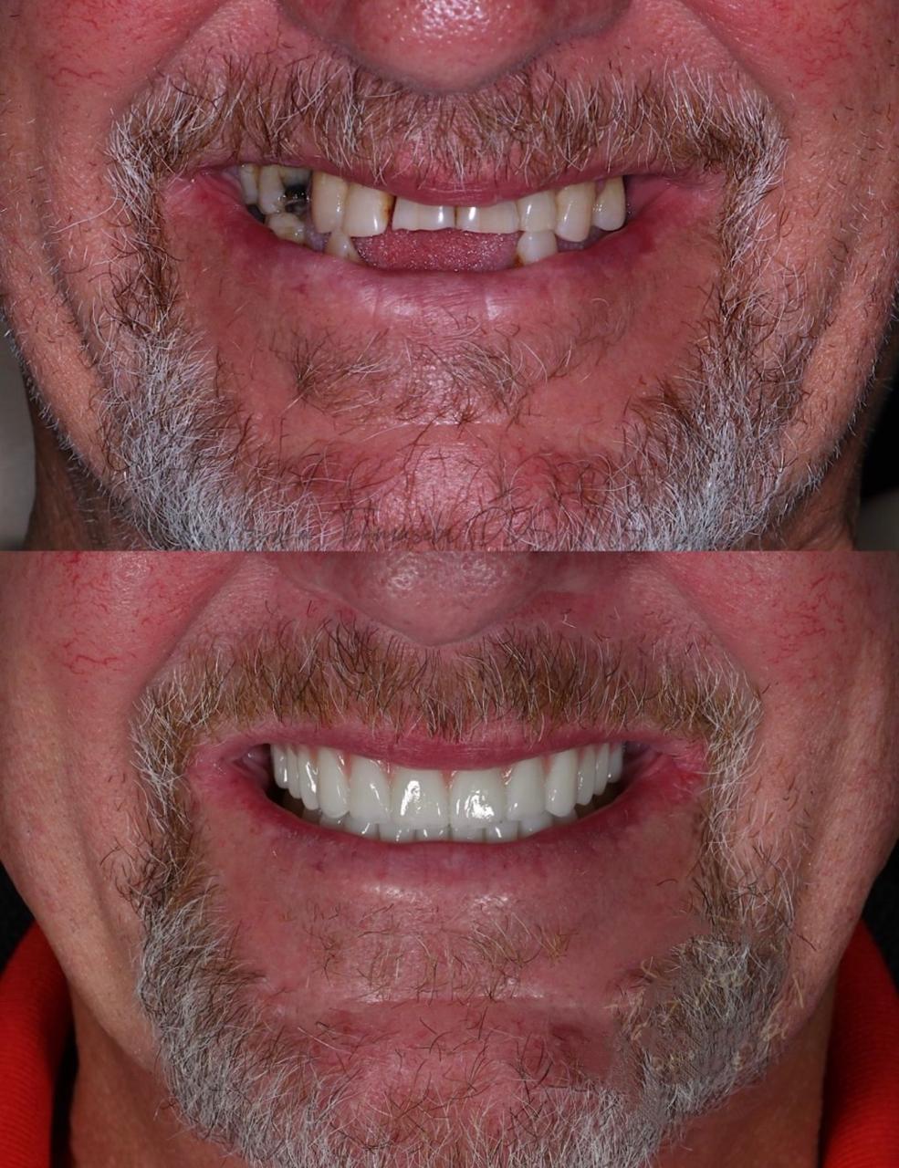 Before and after close-up of a man's mouth showing dental restoration; upper image with damaged and missing teeth and lower image with a full set of white, restored teeth.