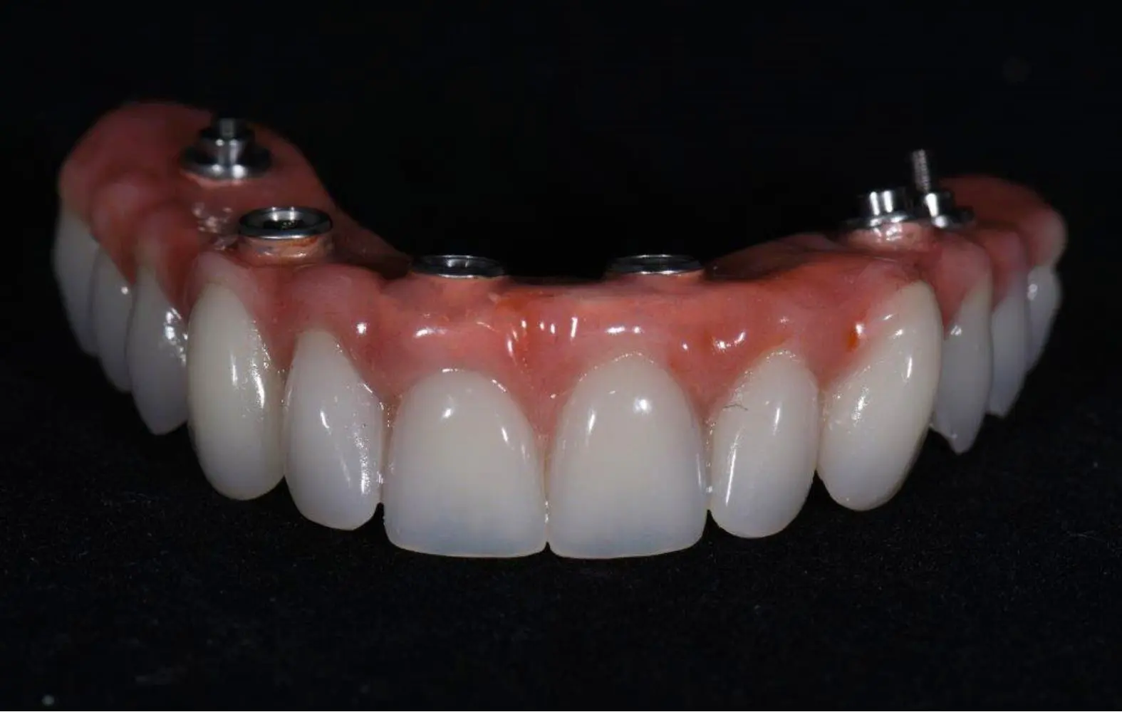 Image of an all-on-4 acrylic bridge. 