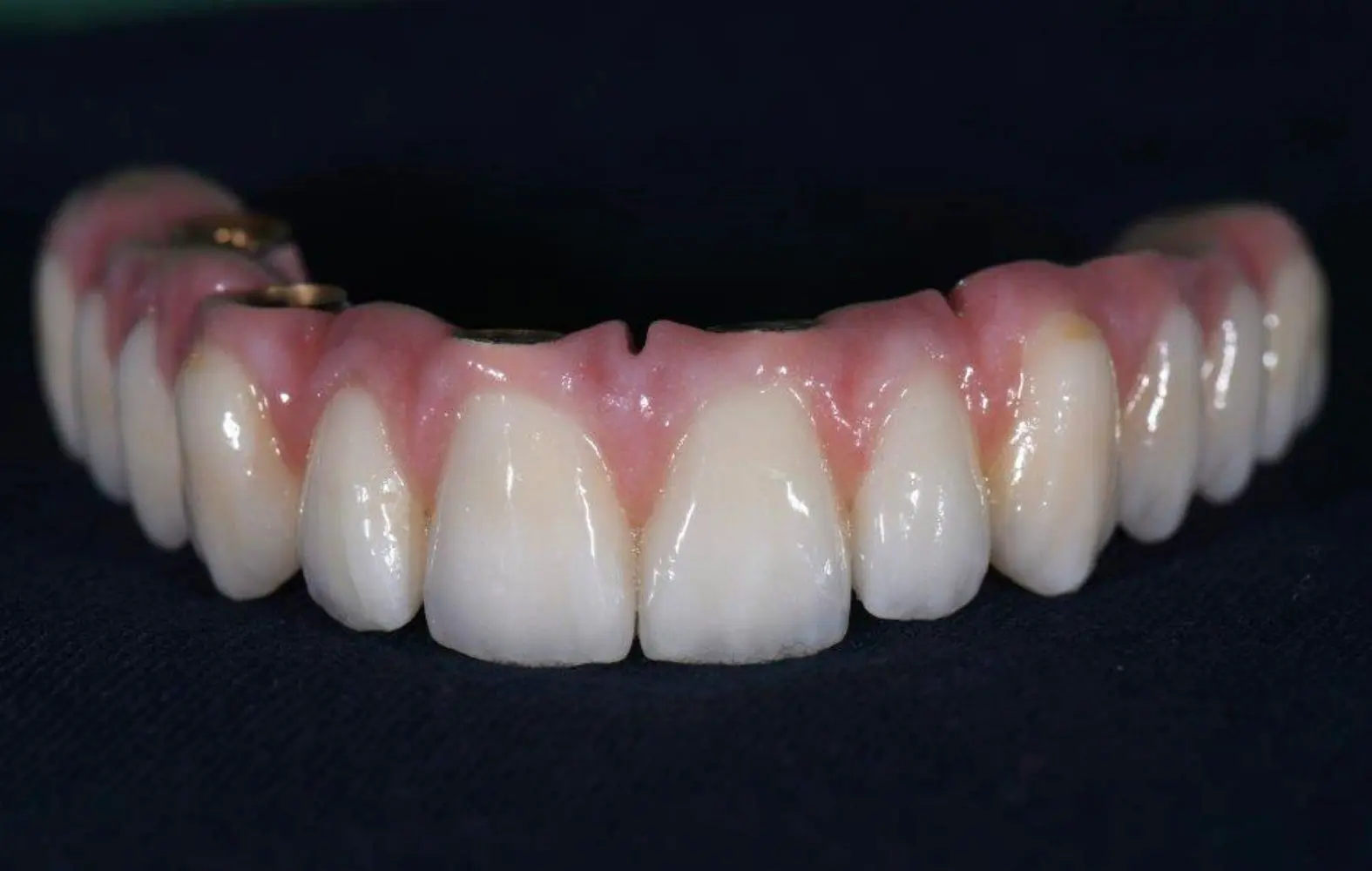 Image of an all-on-4 zirconia bridge. 
