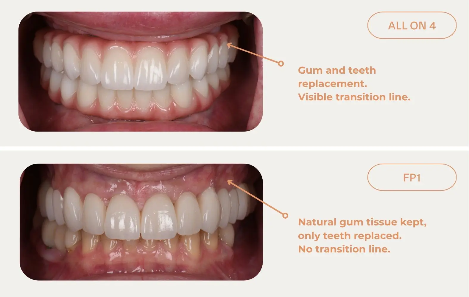 Photo comparison of an all-on-4 treatment and FP1 treatment offered at Macquarie Street Dental.