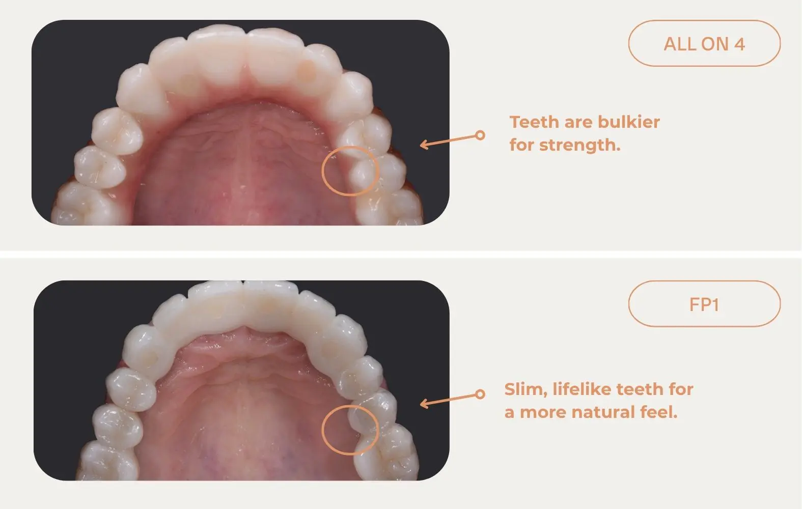 Occlusal photo comparison of an all-on-4 treatment and FP1 treatment completed at Macquarie Street Dental.