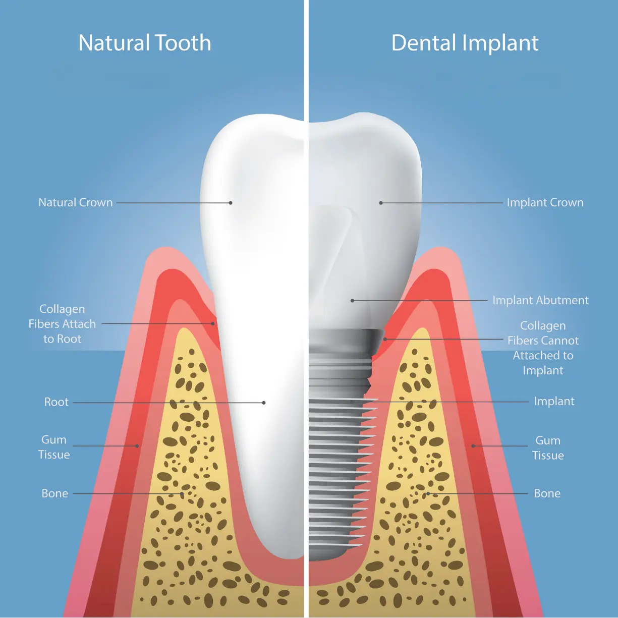 Image of a dental implant vs a natural tooth.