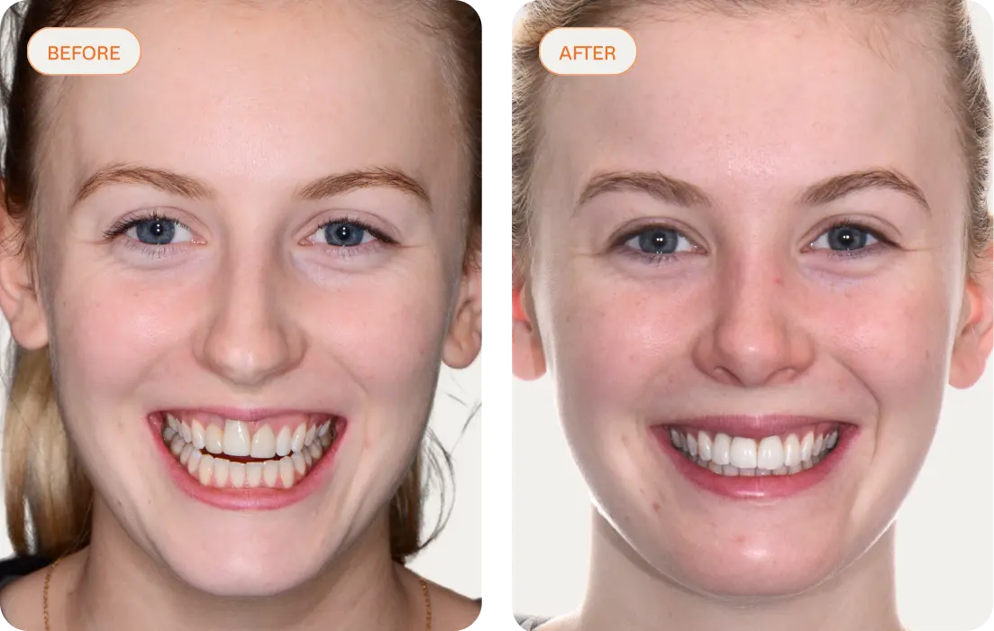 A before and after photo of a patient that received a single dental implant at Macquarie Street Dental.