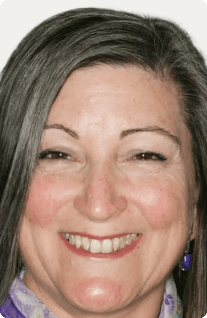 Patient's dental crowns before treatment image.