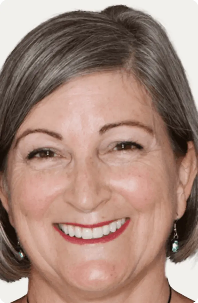 Patient's dental crowns after treatment image.