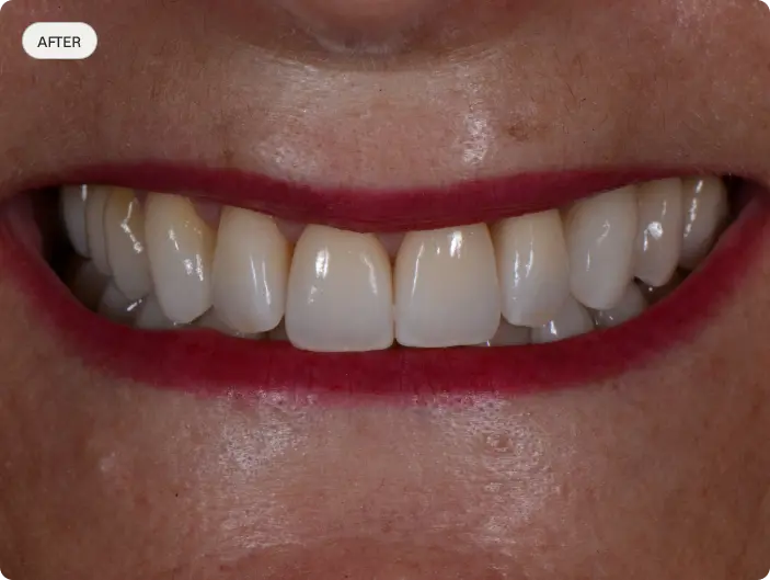 Image of a patient's smile after dental crowns treatment.