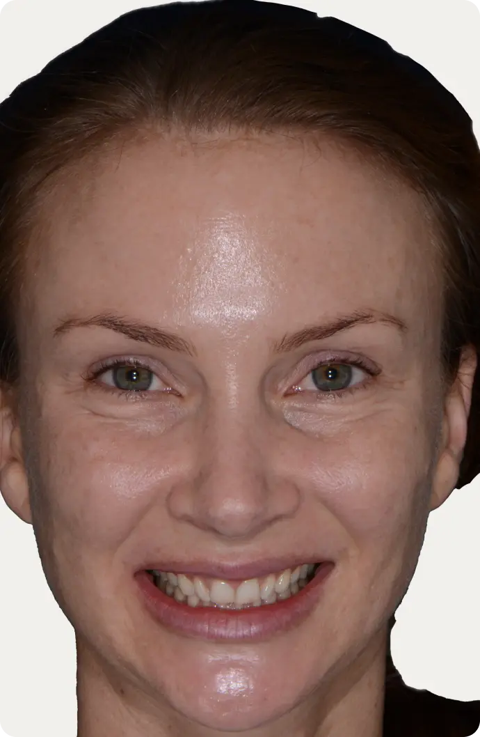 Image of a patient before dental crowns treatment.