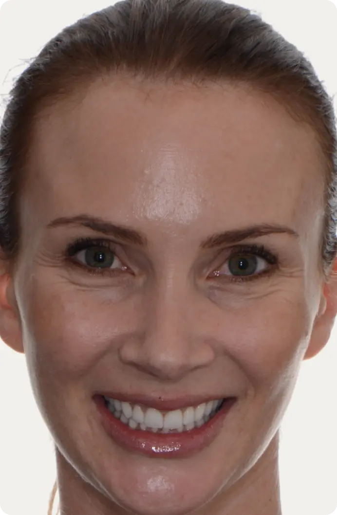 Image of a patient after dental crowns treatment.