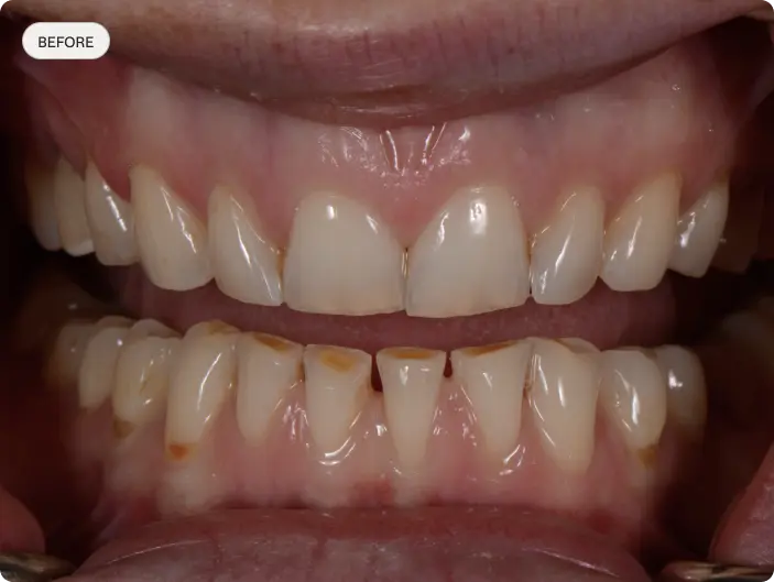 Image of a patient's smile before dental crowns treatment.