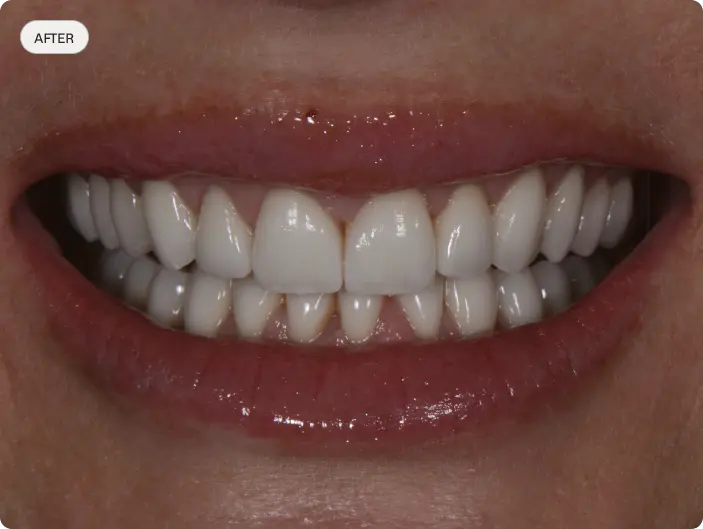 Image of a patient's smile after dental crowns treatment.