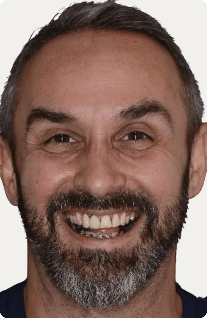 Image of a patient before dental crowns treatment.