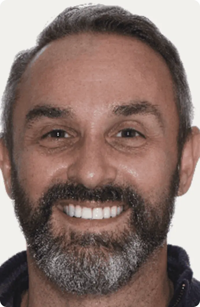 Image of a patient after dental crowns treatment.