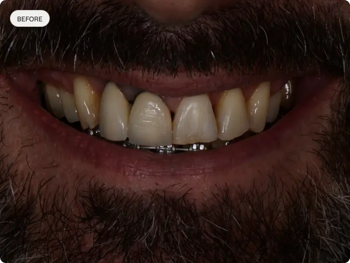 Image of a patient's smile before dental crowns treatment.