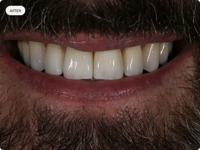 Image of a patient's smile before dental crowns treatment.