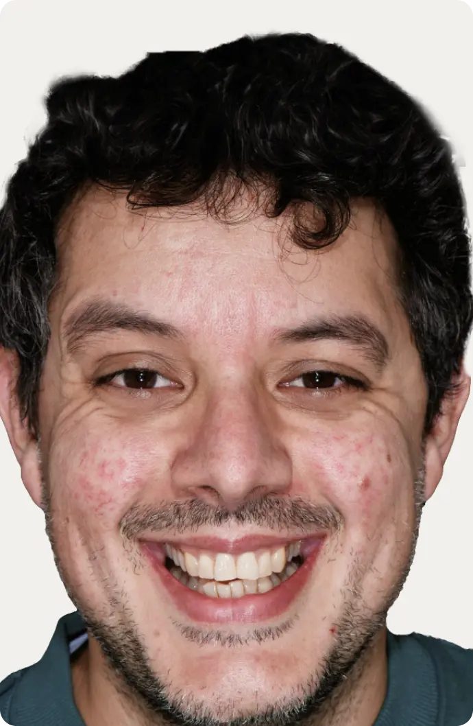 Image of a patient before having a Smile Makeover at Macquarie Street Dental.