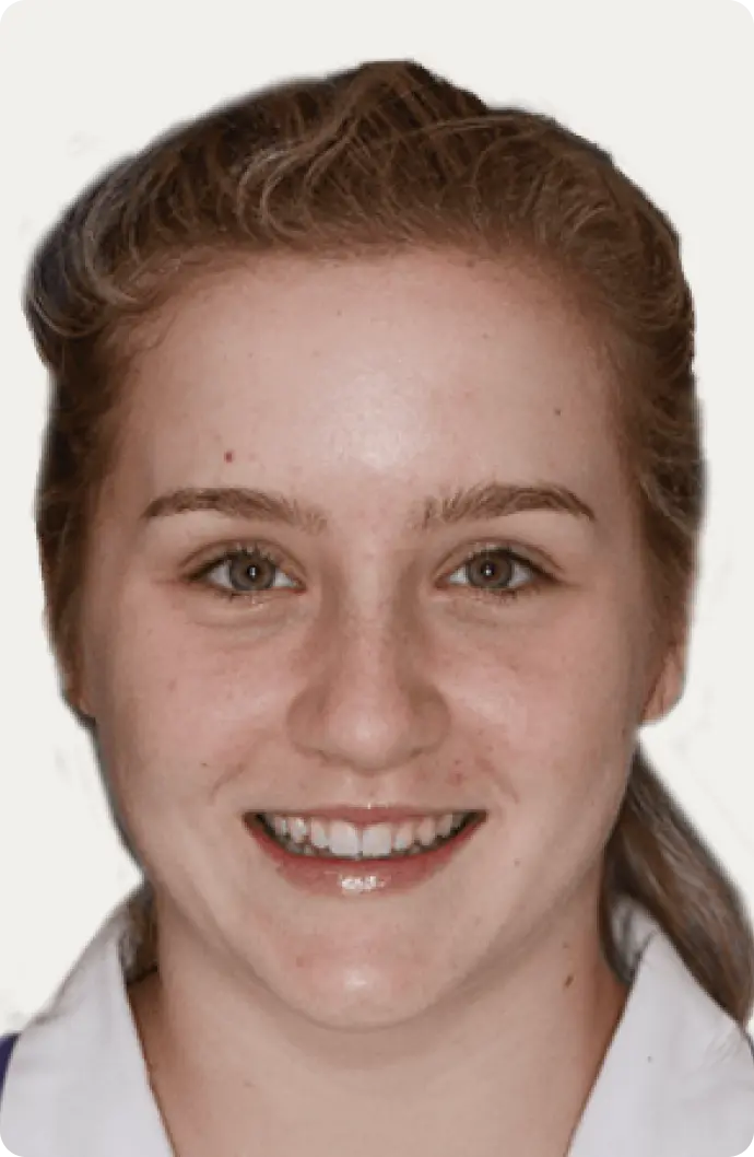 Image of a patient before porcelain veneers at Macquarie Street Dental.