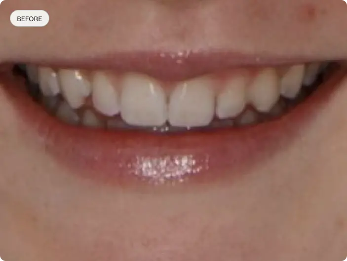 Image of a patient's smile before porcelain veneers at Macquarie Street Dental.