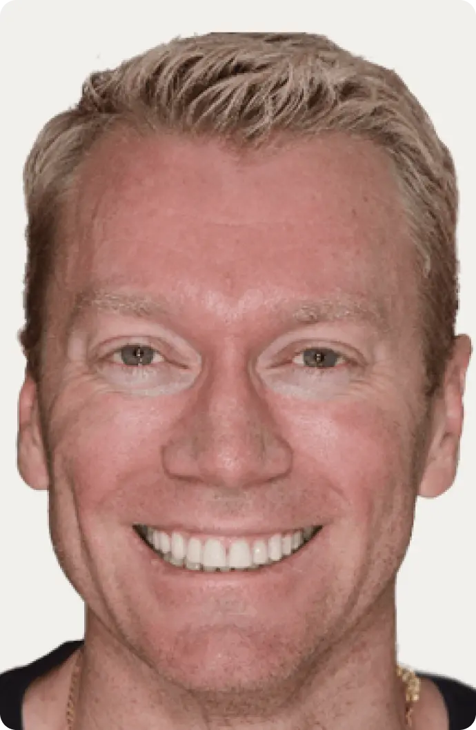 Image of a patient before porcelain veneers at Macquarie Street Dental.