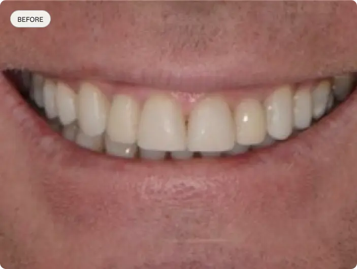 Image of a patient's smile before porcelain veneers at Macquarie Street Dental.