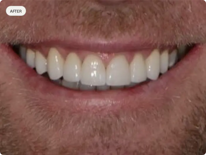 Image of a patient's smile after porcelain veneers at Macquarie Street Dental.