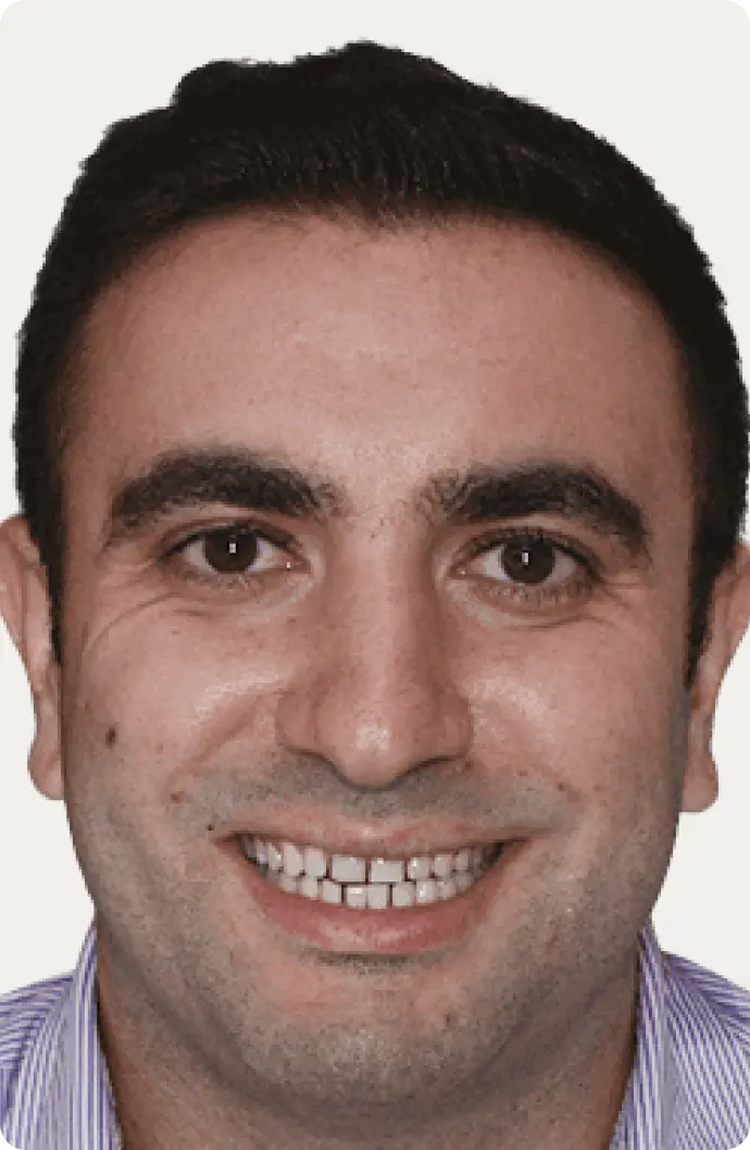 Image of a patient before porcelain veneers at Macquarie Street Dental.