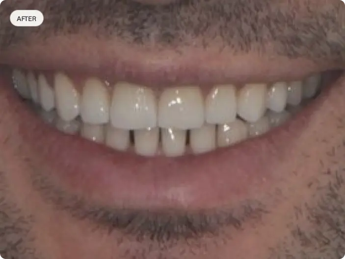Image of a patient's smile after porcelain veneers at Macquarie Street Dental.