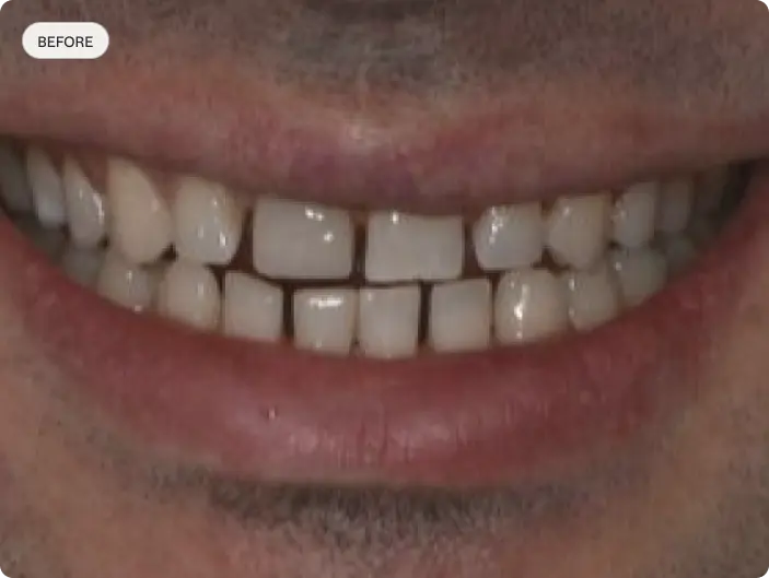 Image of a patient's smile before porcelain veneers at Macquarie Street Dental.