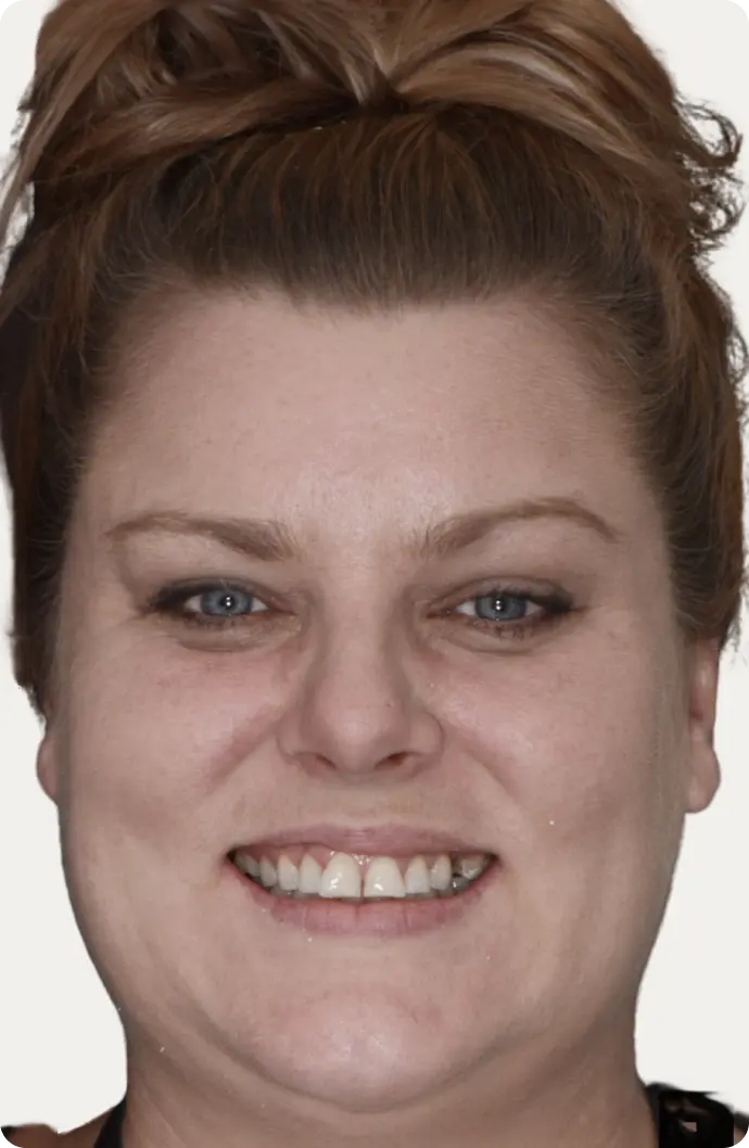 Image of a patient before porcelain veneers at Macquarie Street Dental.