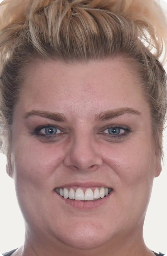 Image of a patient after porcelain veneers at Macquarie Street Dental.