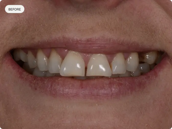 Image of a patient's smile before porcelain veneers at Macquarie Street Dental.