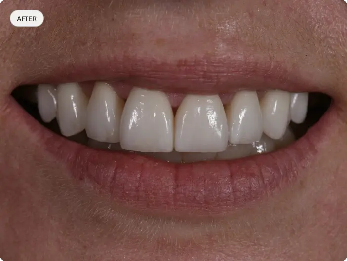 Image of a patient's smile after porcelain veneers at Macquarie Street Dental.