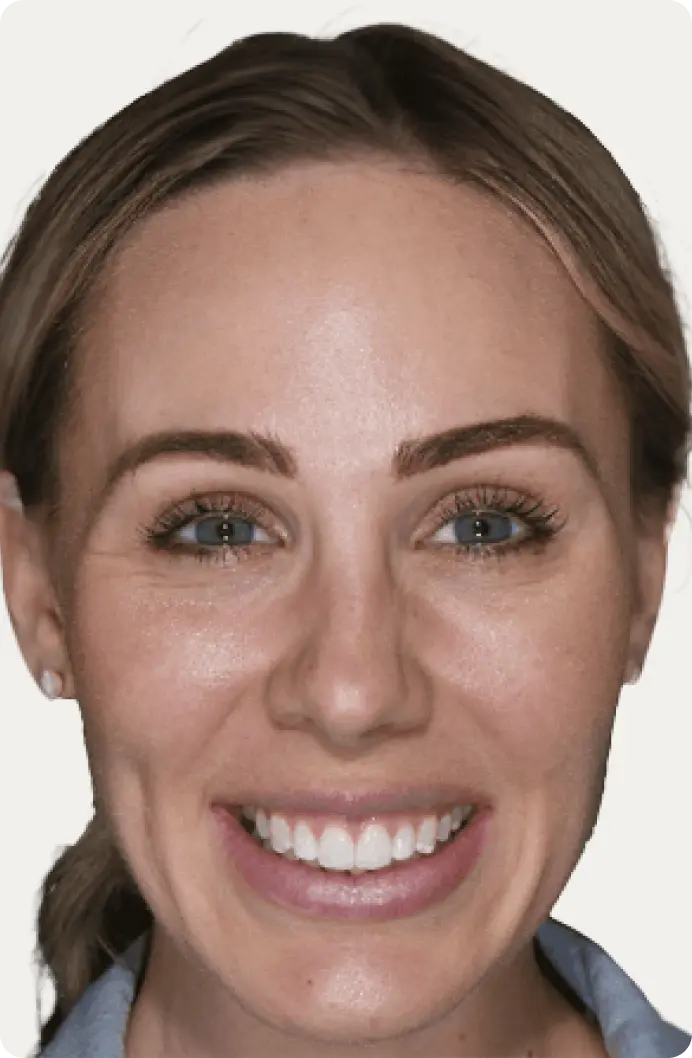 Image of a patient after having Invisalign treatment at Macquarie Street Dental.