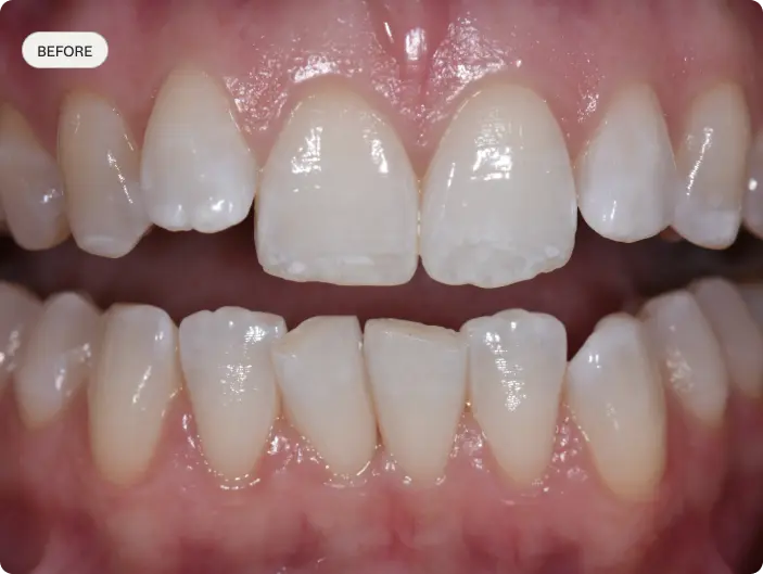 Image of a patient's smile before having Invisalign treatment at Macquarie Street Dental.