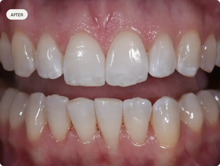 Image of a patient's smile after having Invisalign treatment at Macquarie Street Dental.