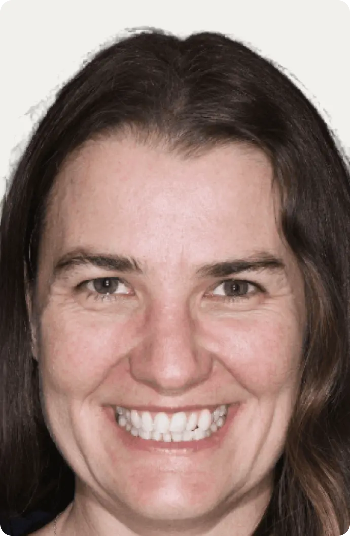 Image of a patient before having Invisalign treatment at Macquarie Street Dental.